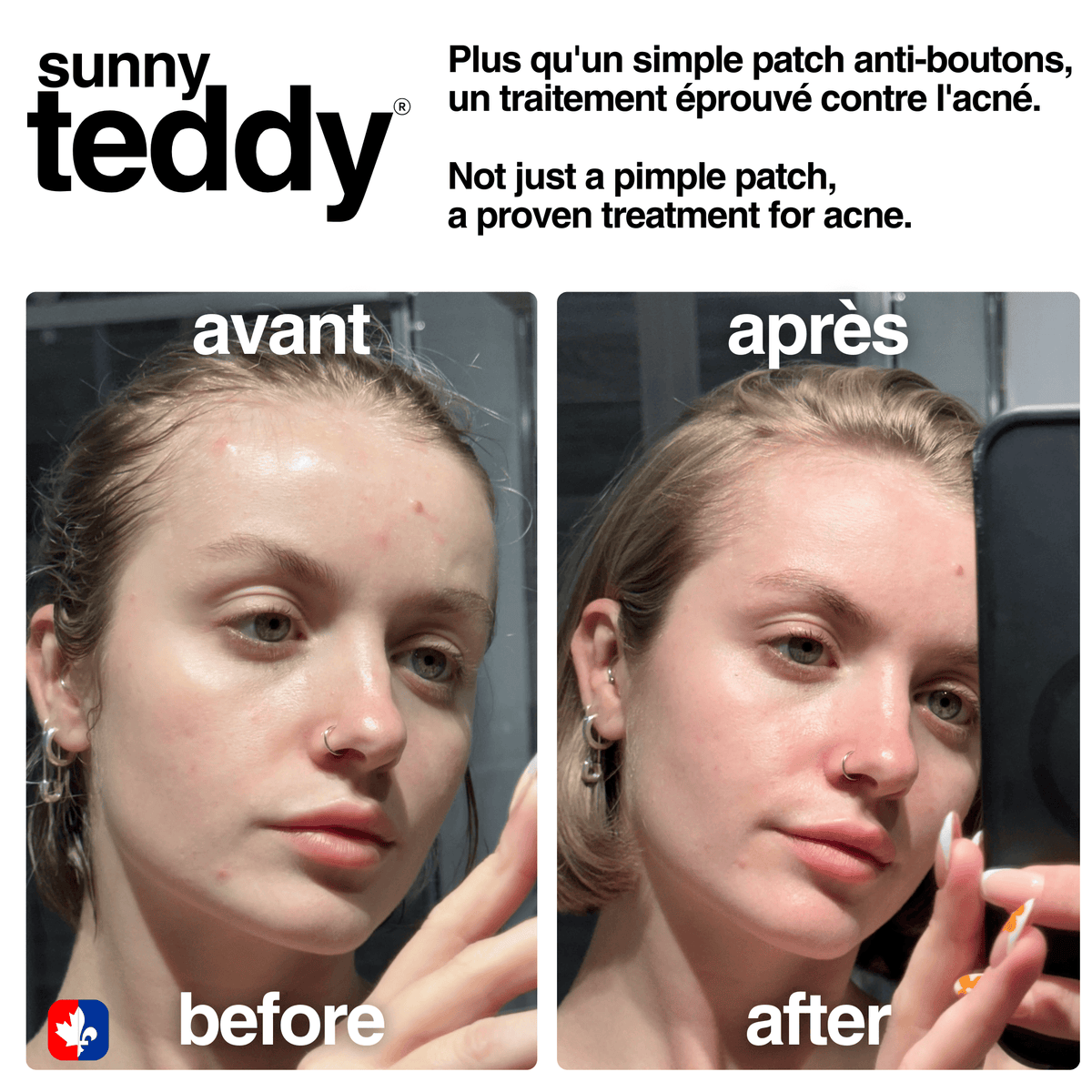 Cute Teddy Acne & Pimple Patchs - Pink Teddies